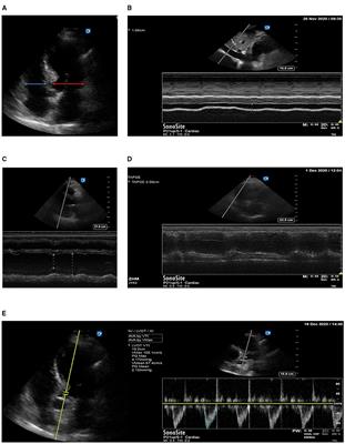 High Central Venous Pressure and Right Ventricle Size Are Related to Non-decreased Left Ventricle Stroke Volume After Negative Fluid Balance in Critically Ill Patients: A Single Prospective Observational Study